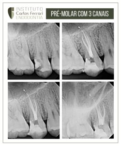 Read more about the article Pré-molar superior com 3 canais. Tratamento endodôntico.