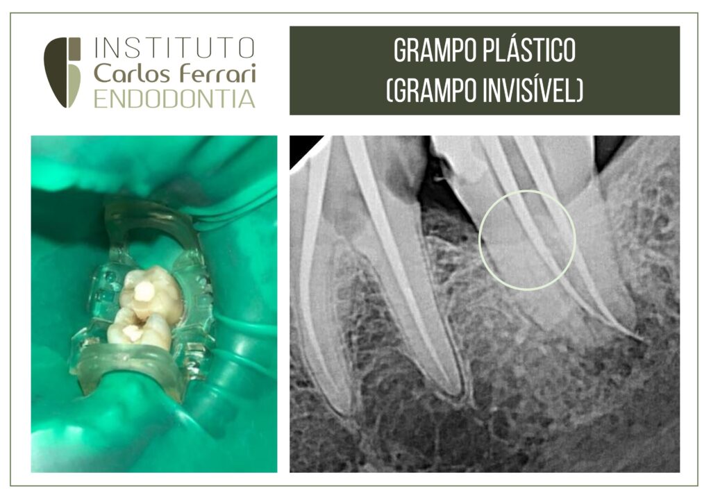 Read more about the article Plastic endodontic clamp (invisible clamp)