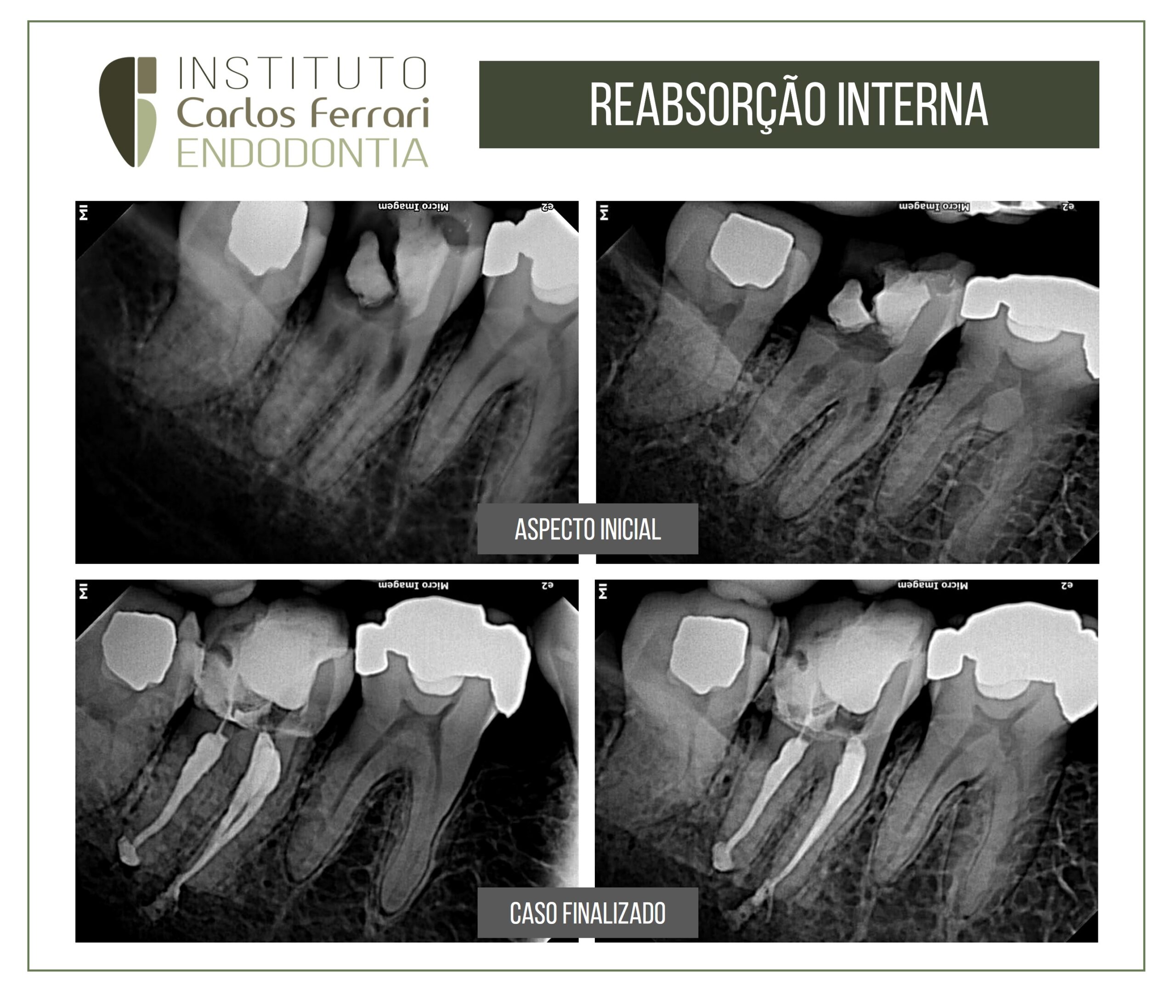 Estás viendo Reabsorción radicular interna en molar inferior.