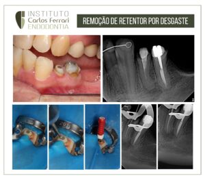Read more about the article Intraradicular retainer. Removal by wear.