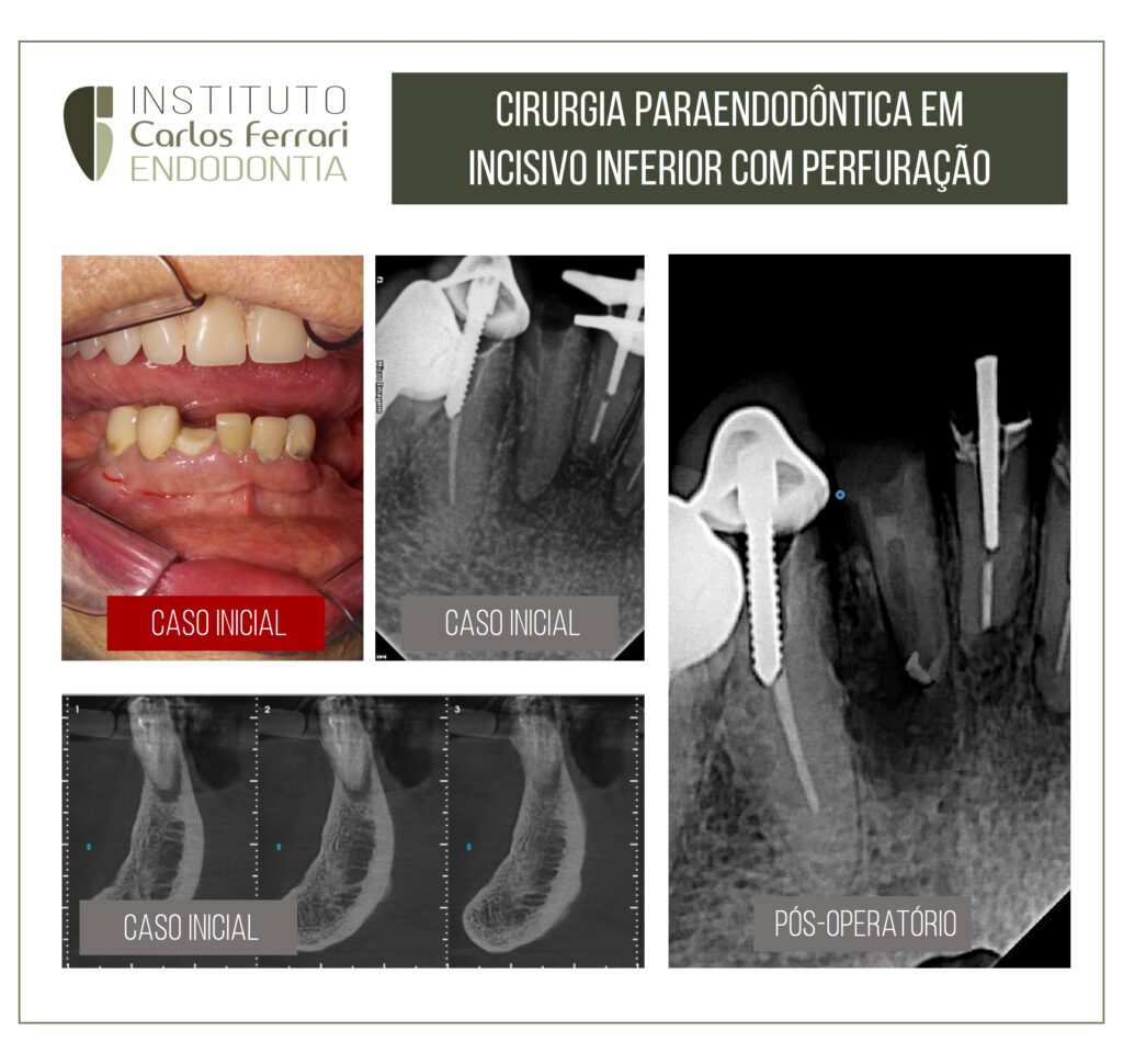 Read more about the article Cirurgia paraendodôntica incisivo inferior com perfuração.