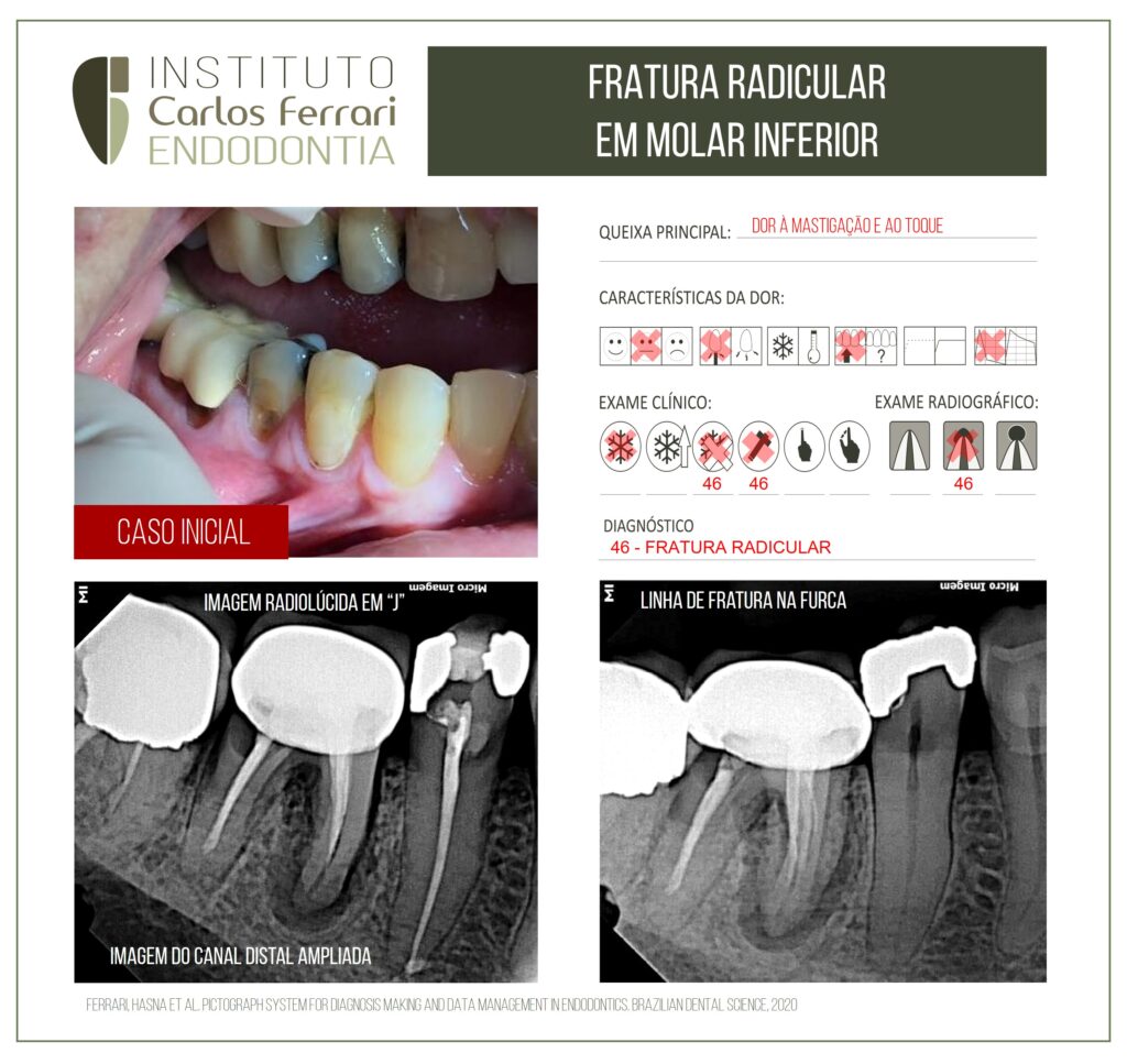 Read more about the article Fratura radicular em molar inferior