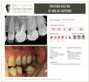 Leer más sobre el artículo Fractura radicular de un molar. Caso clínico.
