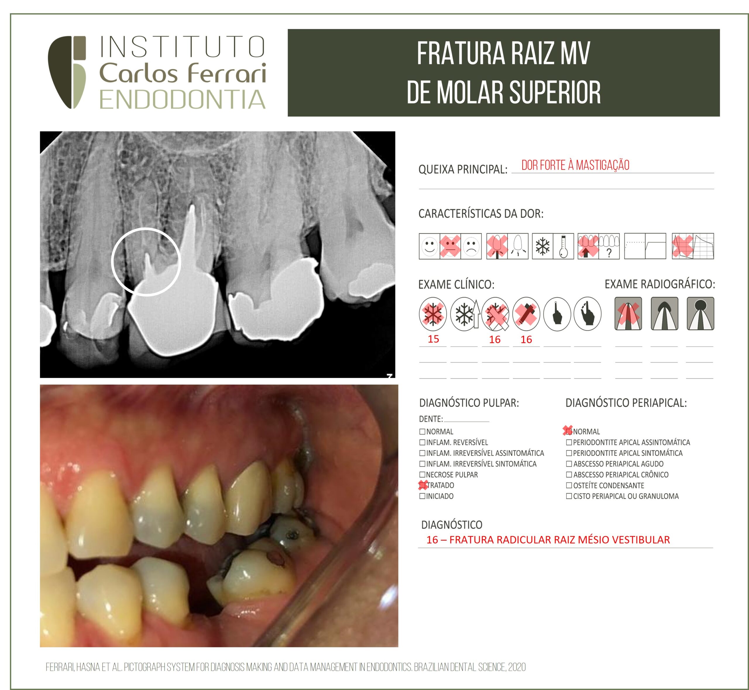 You are currently viewing Fratura radicular de molar. Relato de caso.