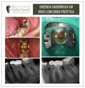Leer más sobre el artículo Urgencia endodóntica en molar con corona metálica.