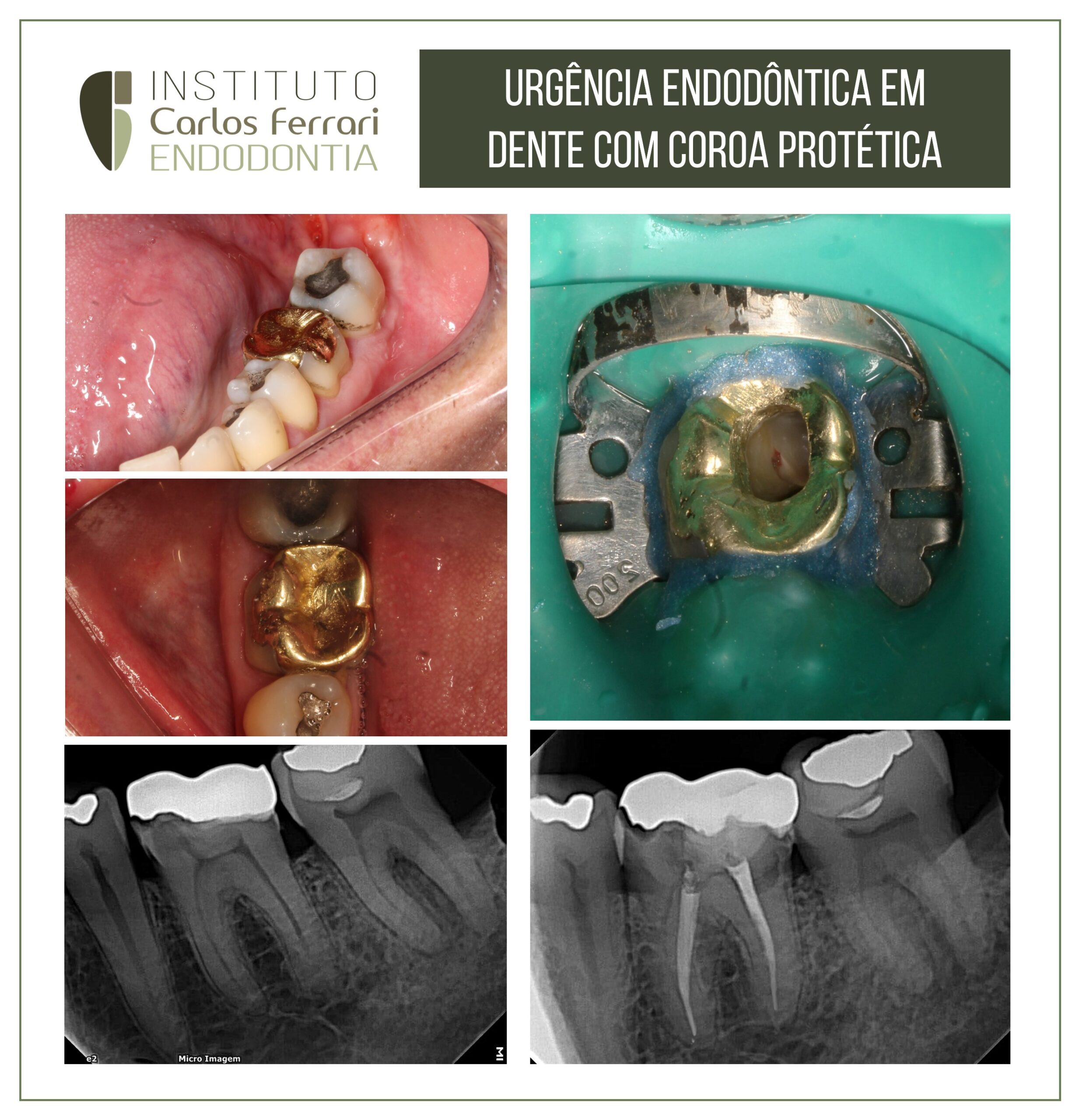 Estás viendo Urgencia endodóntica en molar con corona metálica.