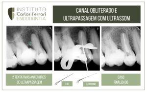 Read more about the article Obliterated canal and ultrasound.