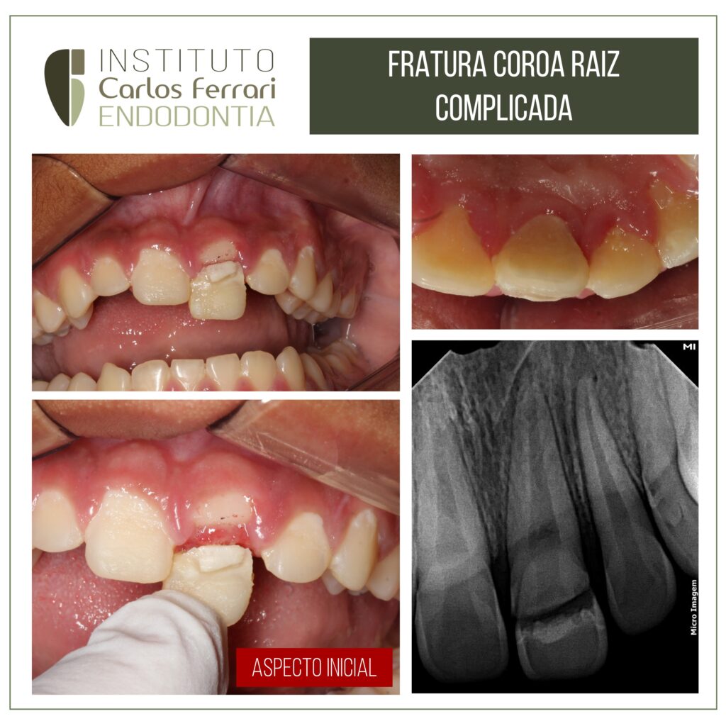 Read more about the article Traumatismo dental. Fratura coroa raiz não complicada.