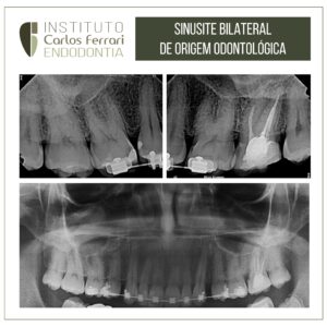 Read more about the article Sinusite odontogênica bilateral