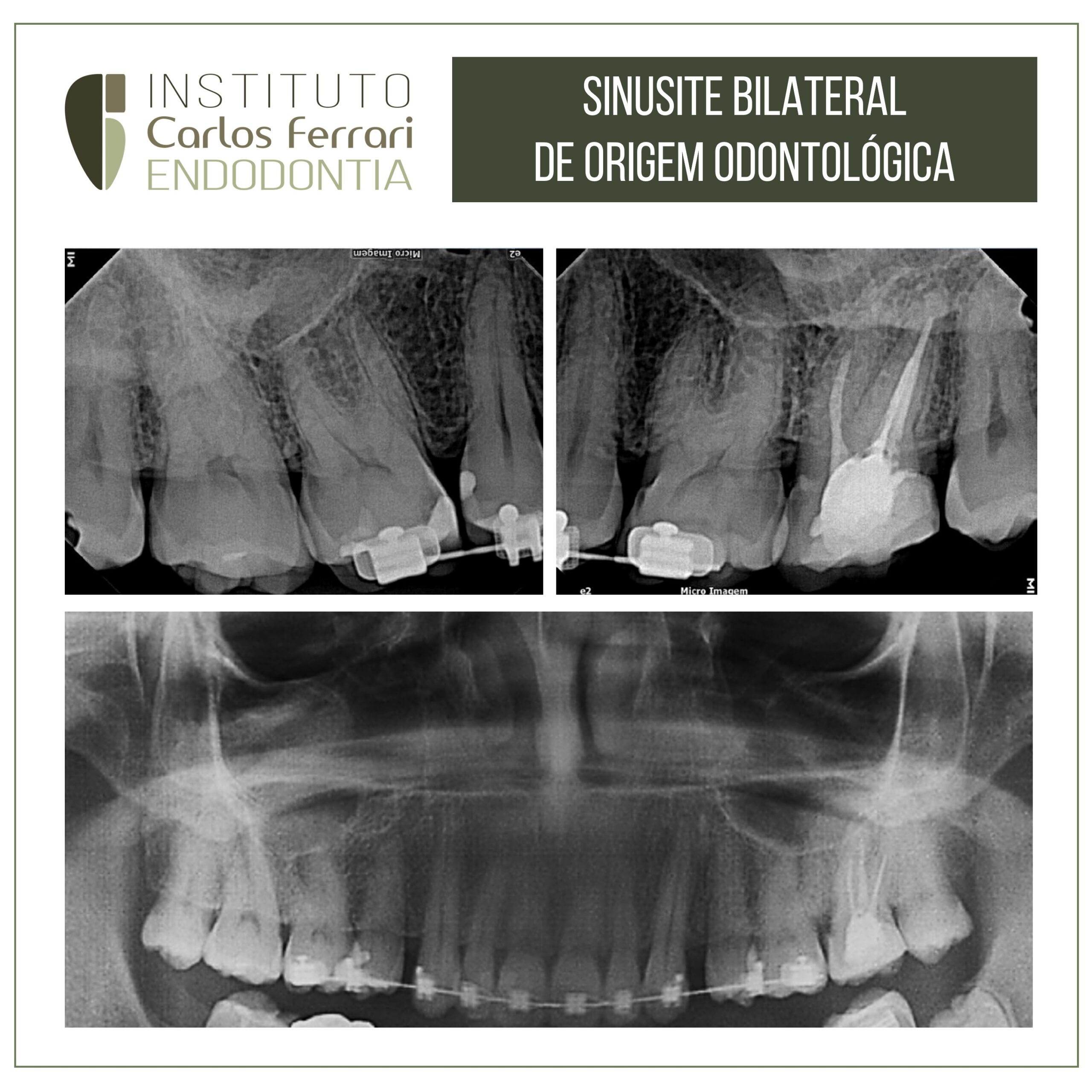 You are currently viewing Sinusite odontogênica bilateral
