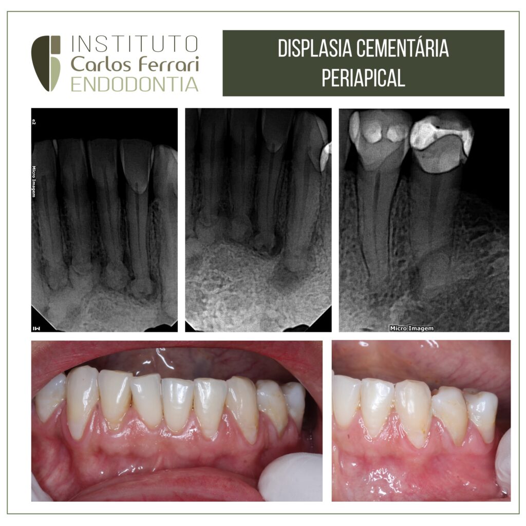 Read more about the article Displasia cementária periapical. Relato de caso.