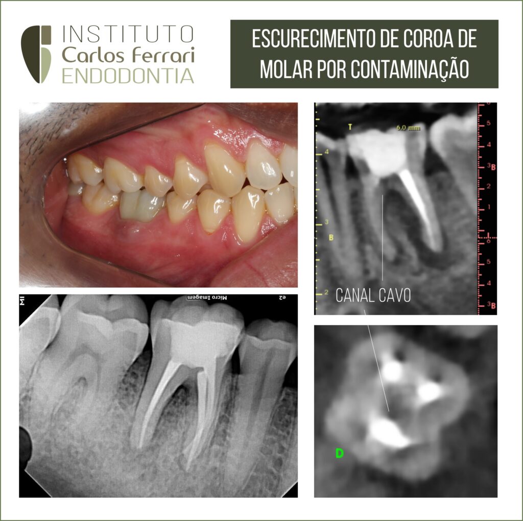 clareamento interno dental