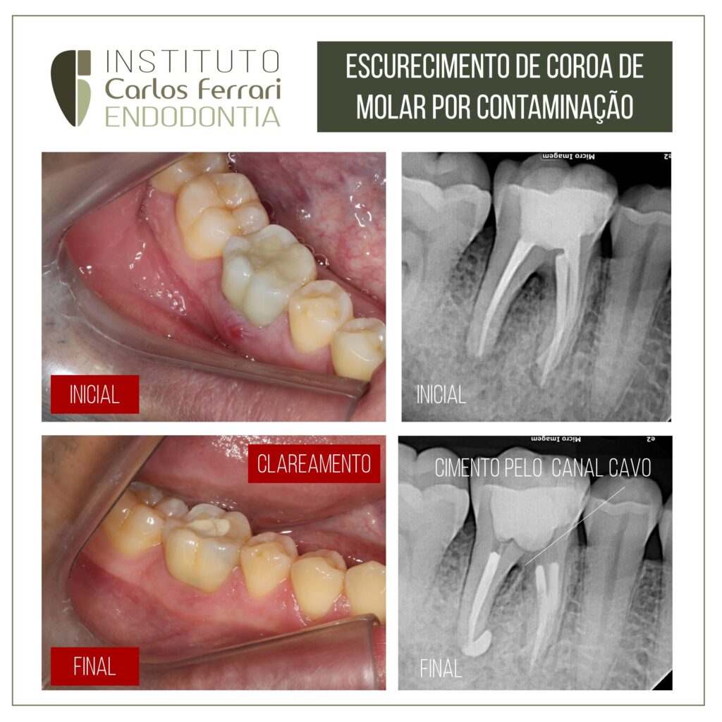 Read more about the article Clareamento interno em molar inferior. Relato de caso.