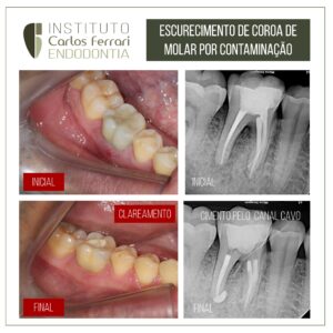 Read more about the article Internal whitening in lower molar. Case report.