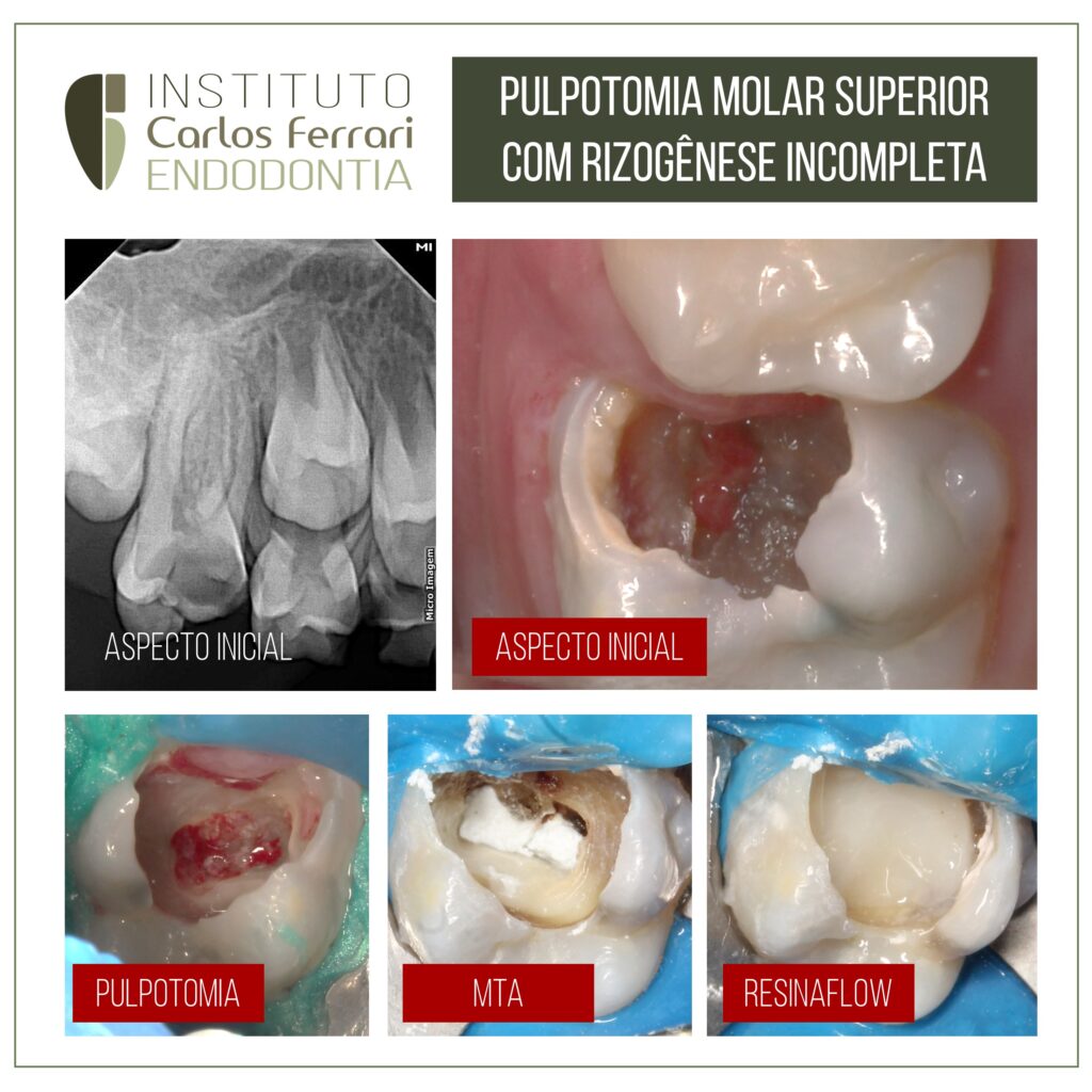 Read more about the article Pulpotomia com MTA em molar superior. Relato de caso.