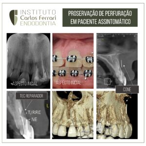 Read more about the article Perfuração endodôntica. Proservação em caso assintomático.