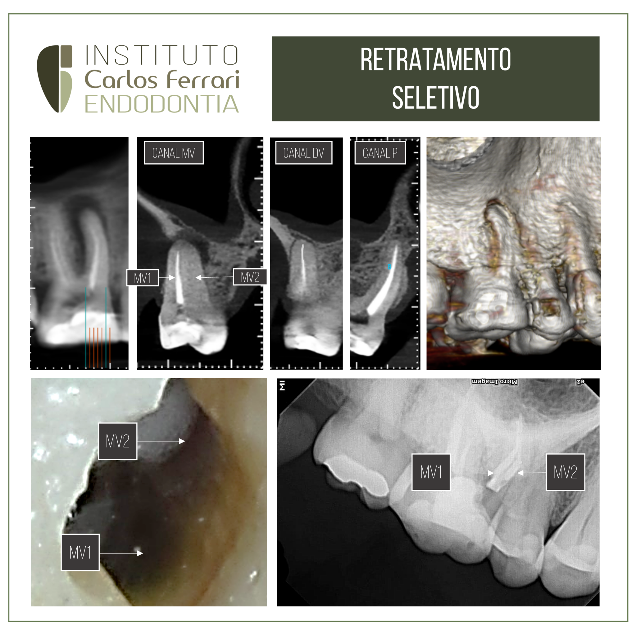 Apicifica O Em Dente Com Rizog Nese Incompleta