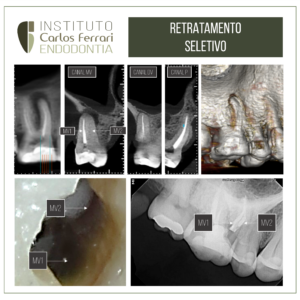 Read more about the article Retratamento endodôntico seletivo. Relato de caso.