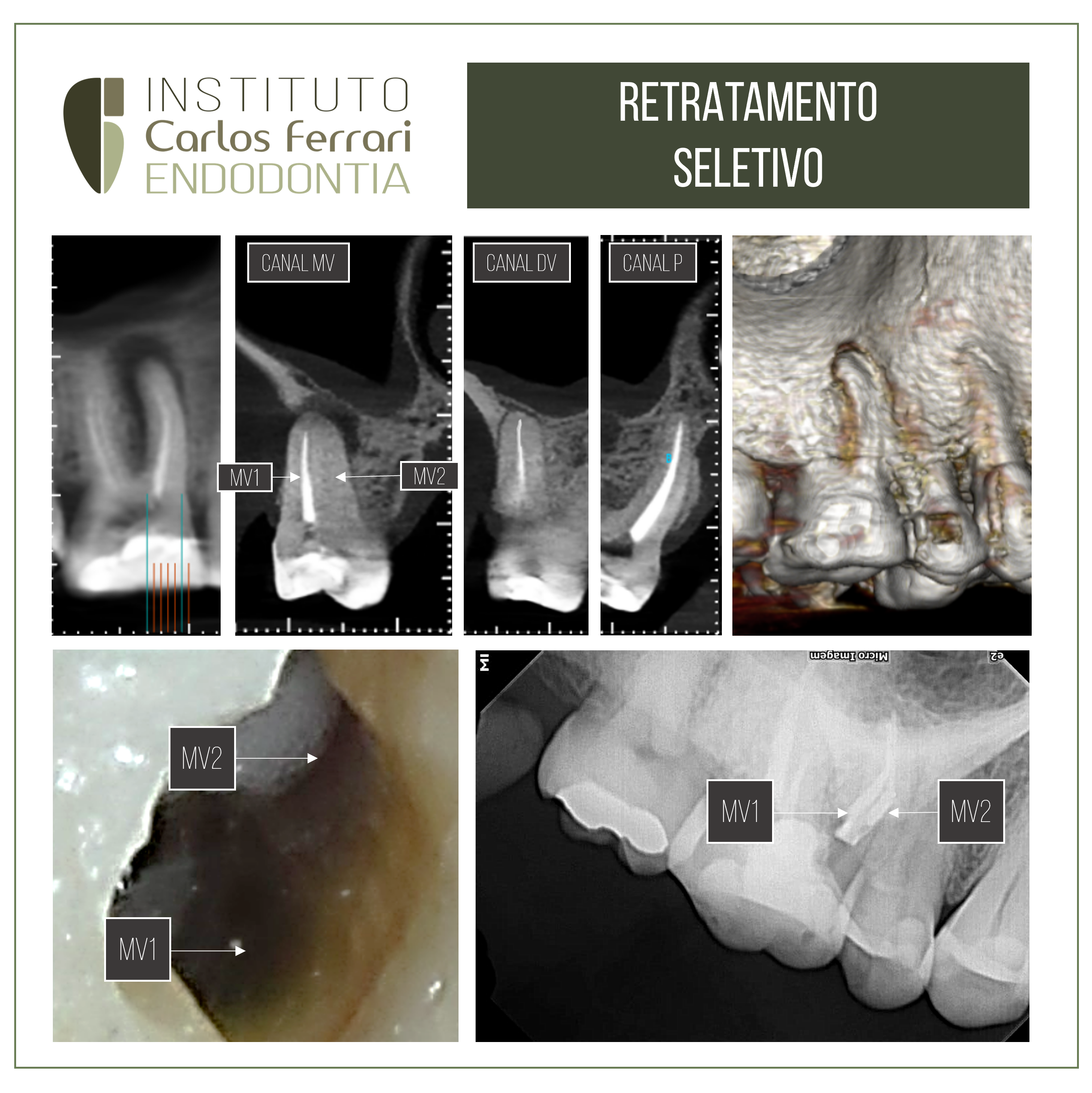 You are currently viewing Selective endodontic retreatment. Case report.