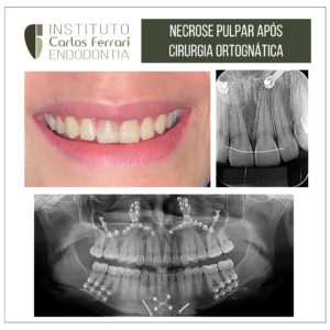 Read more about the article Pulp necrosis after orthognathic surgery. Case report.