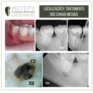 Read more about the article Selective retreatment of mesial canals. Case report.