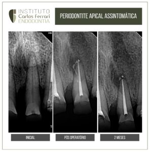 Read more about the article Periodontite apical assintomática. Relato de caso.