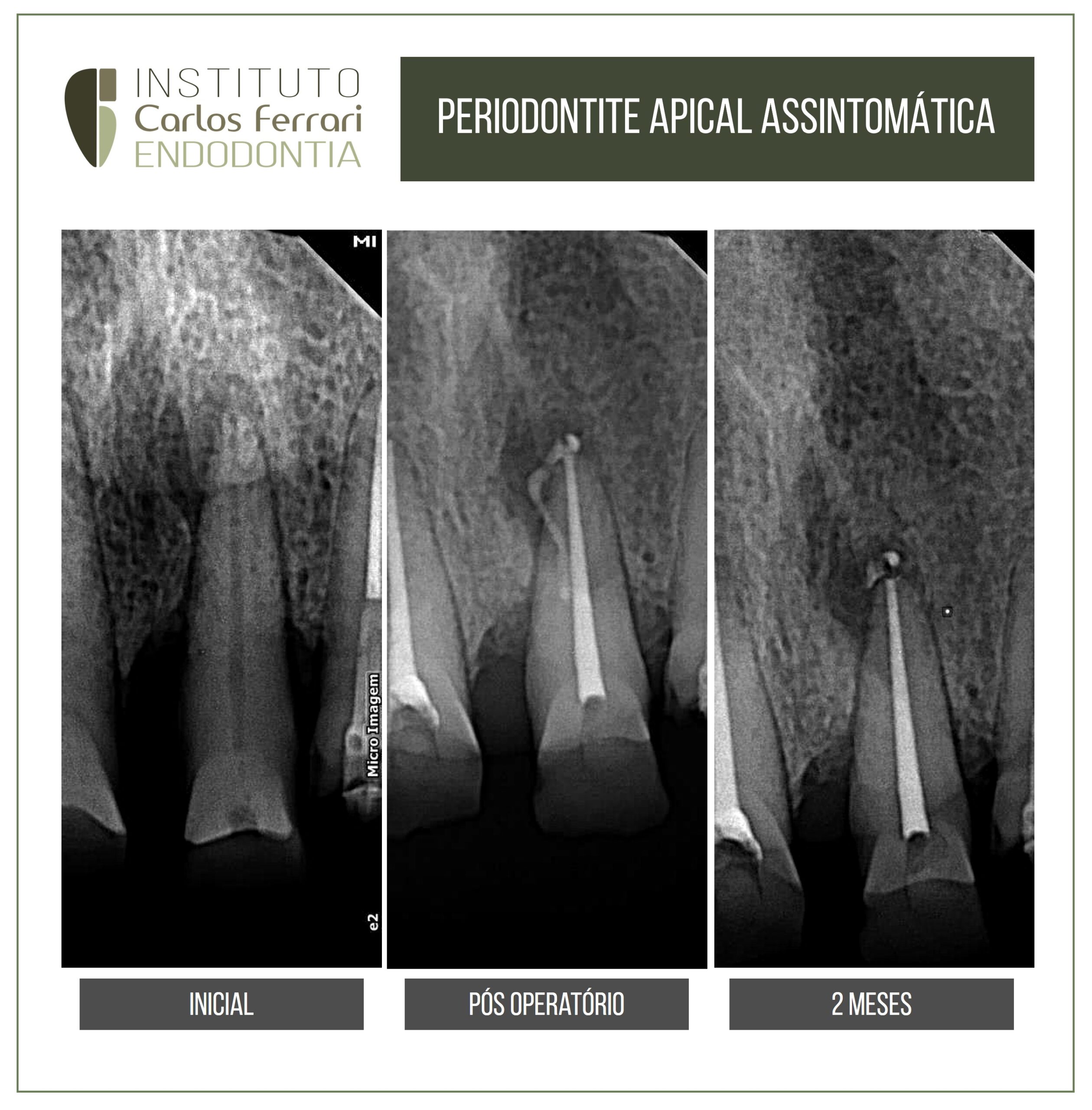 You are currently viewing Asymptomatic apical periodontitis. Case report.