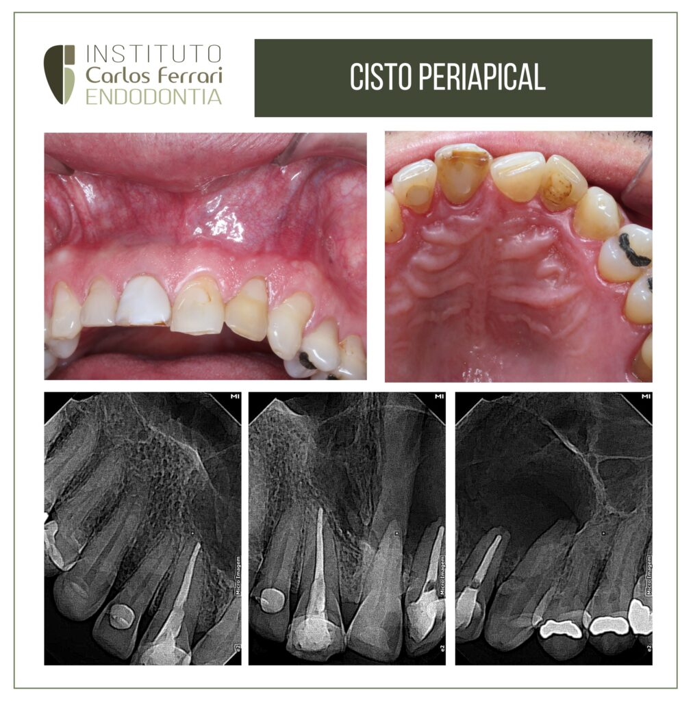 Read more about the article Endodontic treatment of a periapical cyst.