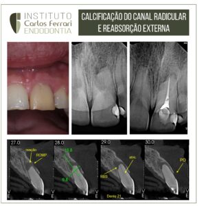 Read more about the article External resorption and calcification. Case report.