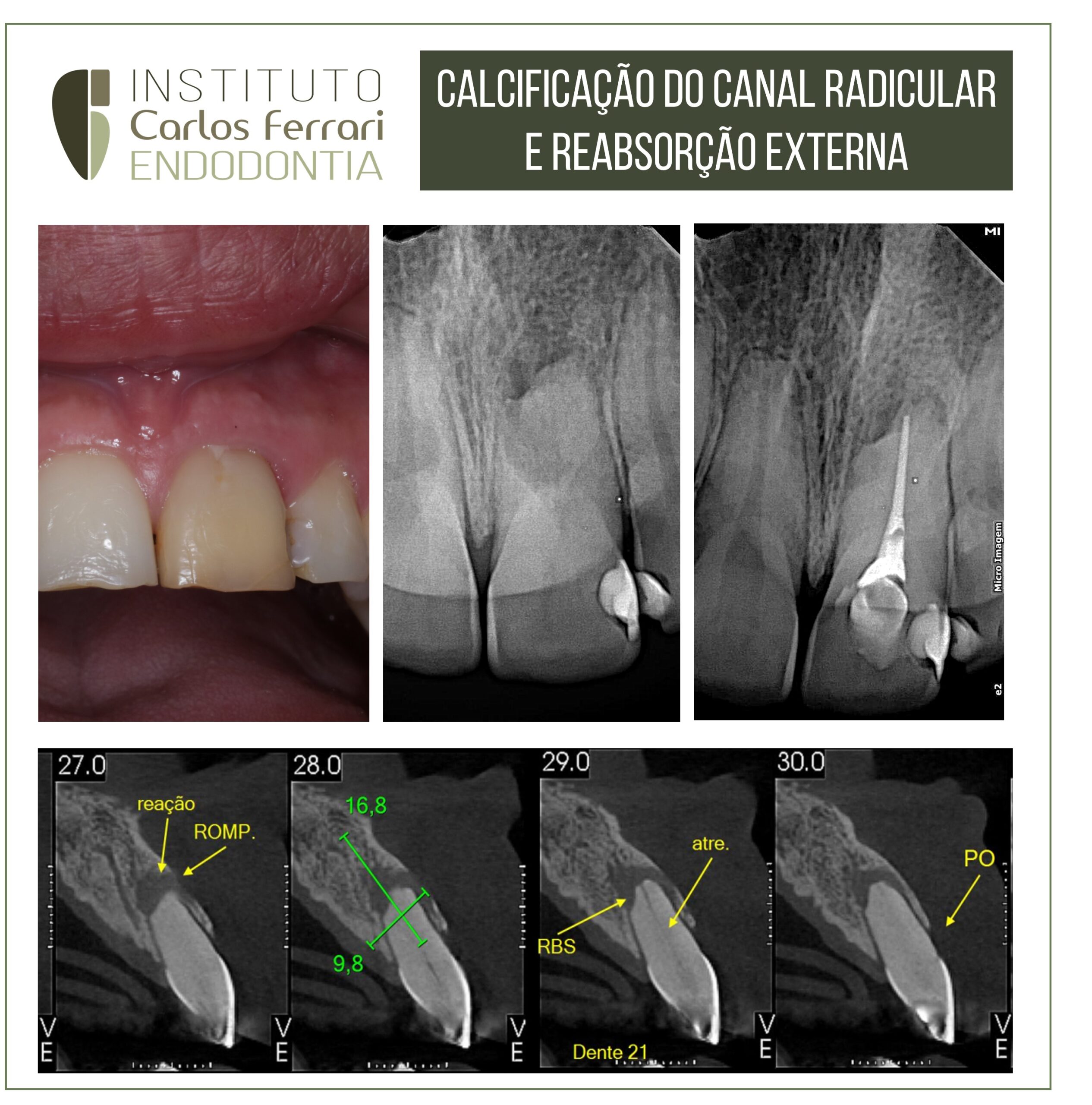 You are currently viewing External resorption and calcification. Case report.