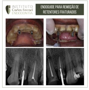 Read more about the article Endoguide for retainer removal
