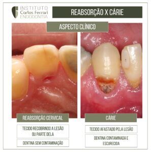 Read more about the article Cervical resorption or caries?