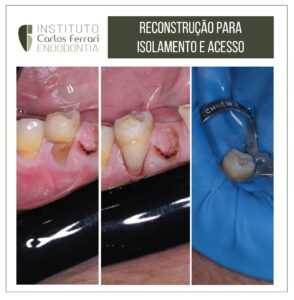 Read more about the article Reconstrução radicular para isolamento e acesso.
