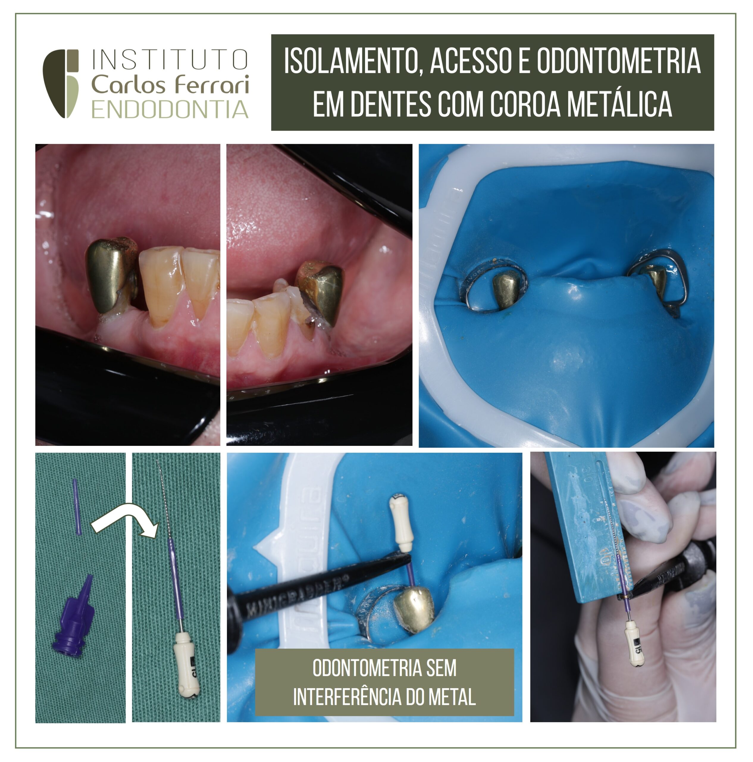 You are currently viewing Endodontics in a prosthetic crown. Adaptation for odontometry.