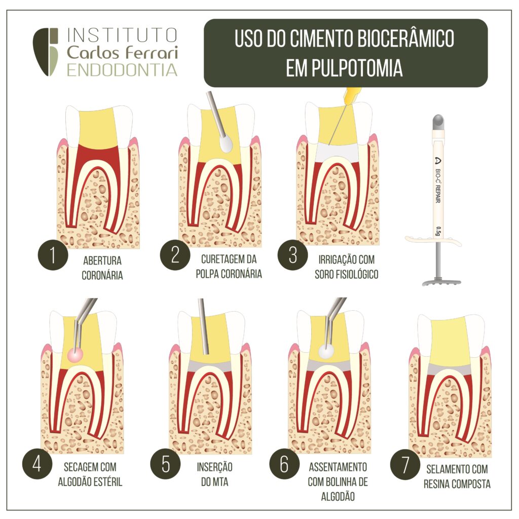Read more about the article Bioceramic cements in pulpotomy.