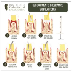 了解更多有关文章 生物陶瓷水门汀在牙髓切断术中的应用的信息。