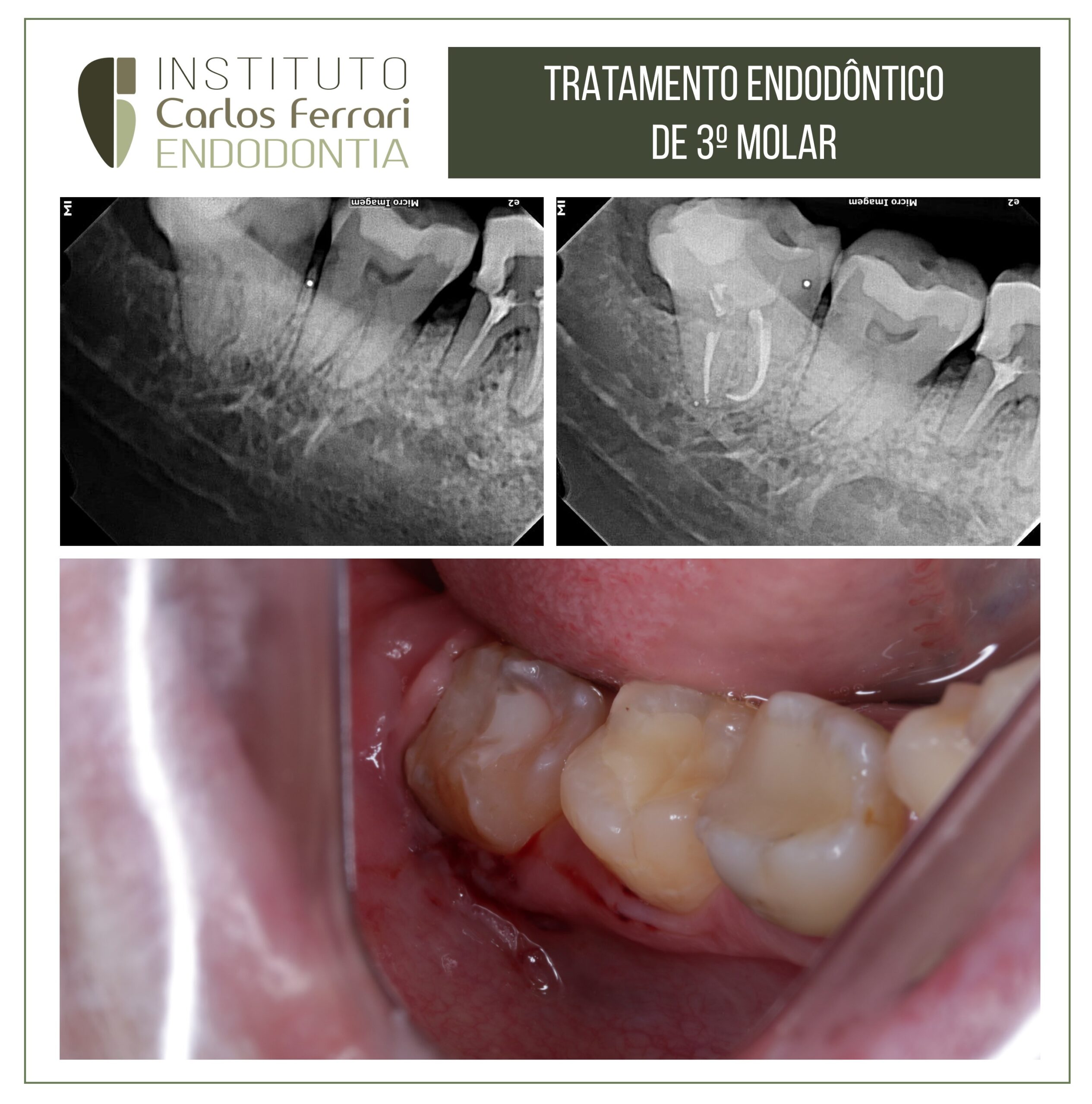 You are currently viewing Tratamento endodôntico de terceiro molar. Relato de caso.