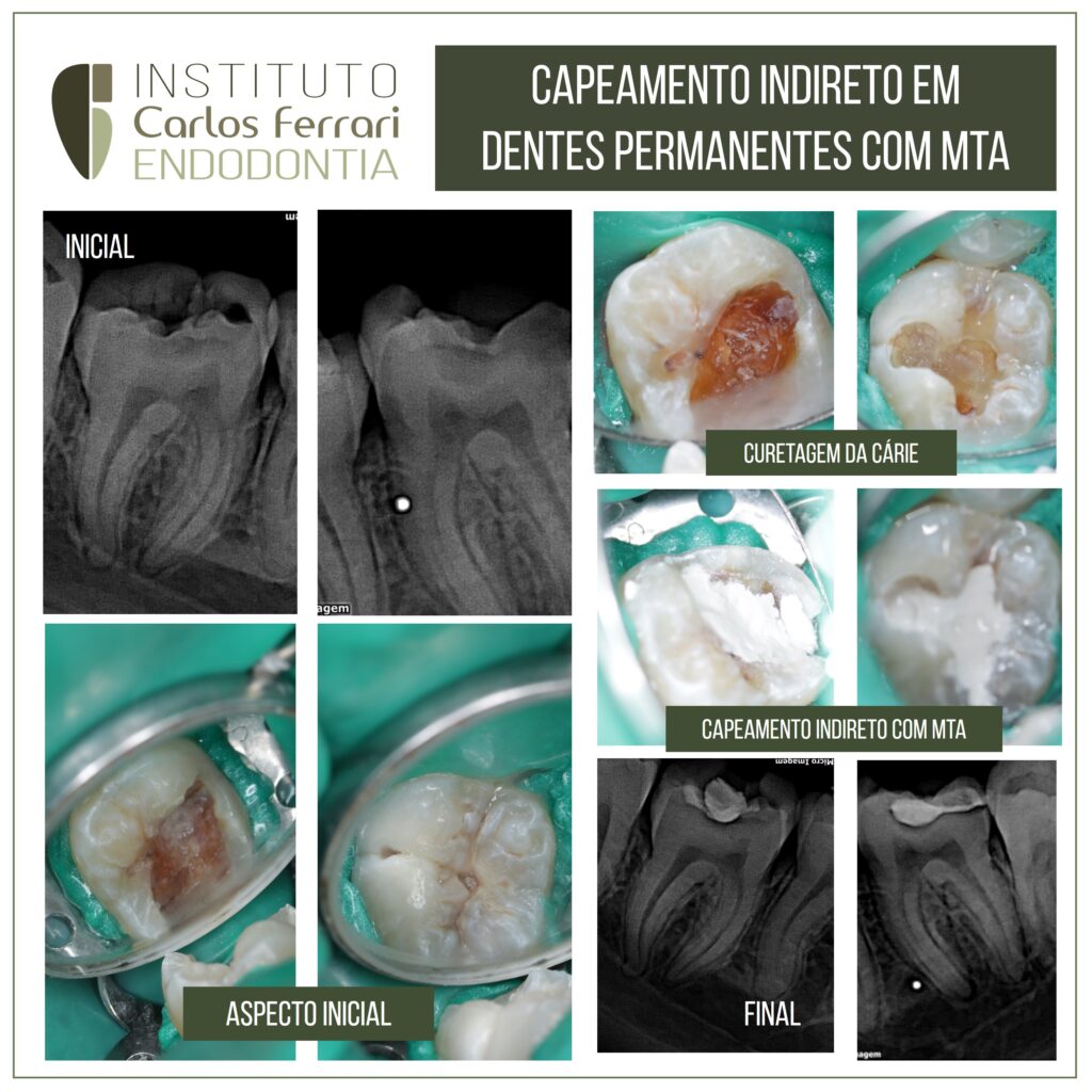 Read more about the article Indirect pulp capping with bioceramic in incomplete rhizogenesis.