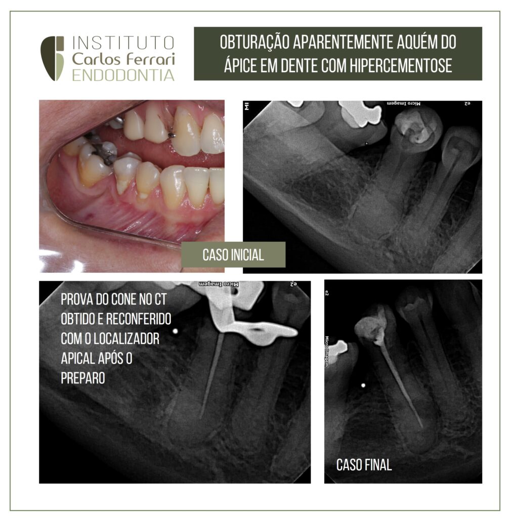 Read more about the article Tooth with hypercementosis. Obturation below the apex.