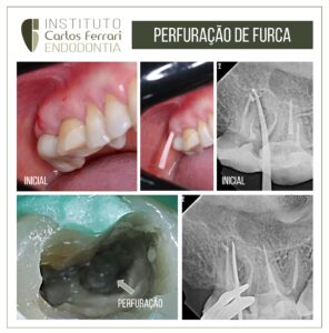 Read more about the article Molar furcation perforation. Sealing with MTA.