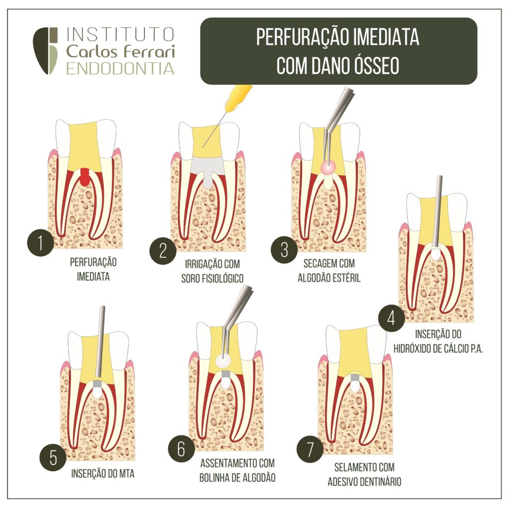 MTA na endodontia