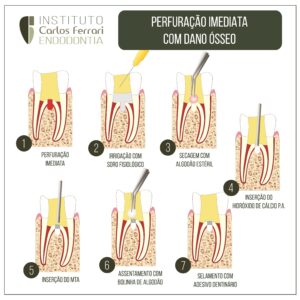 Read more about the article Perfuração radicular com dano ósseo. O que fazer?