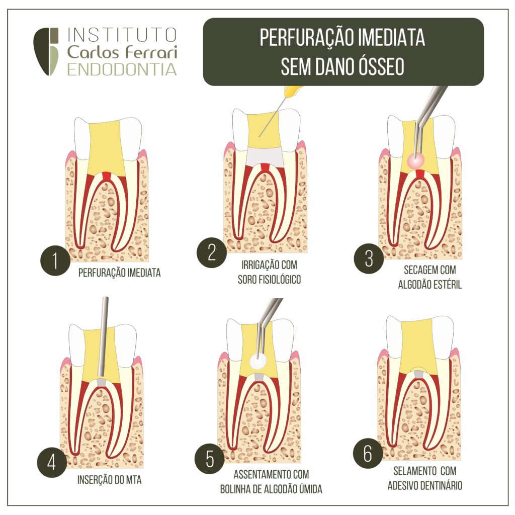 Read more about the article Perfuração radicular sem dano ósseo. O que fazer?