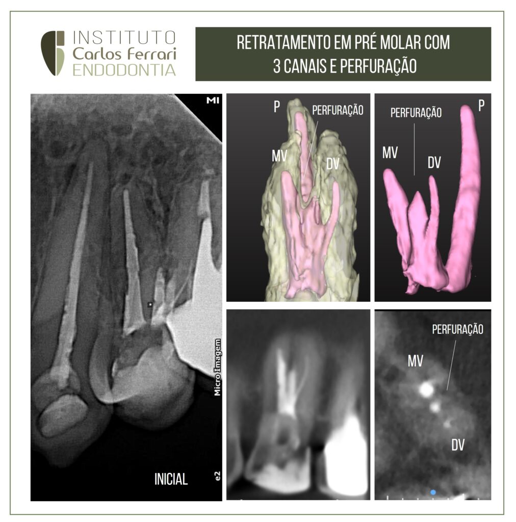 Read more about the article Pré-molar superior com três canais. Tratamento endodôntico.