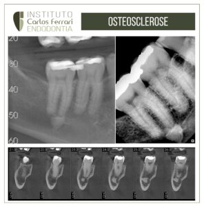 Read more about the article Osteosclerose na região apical. Relato de caso.