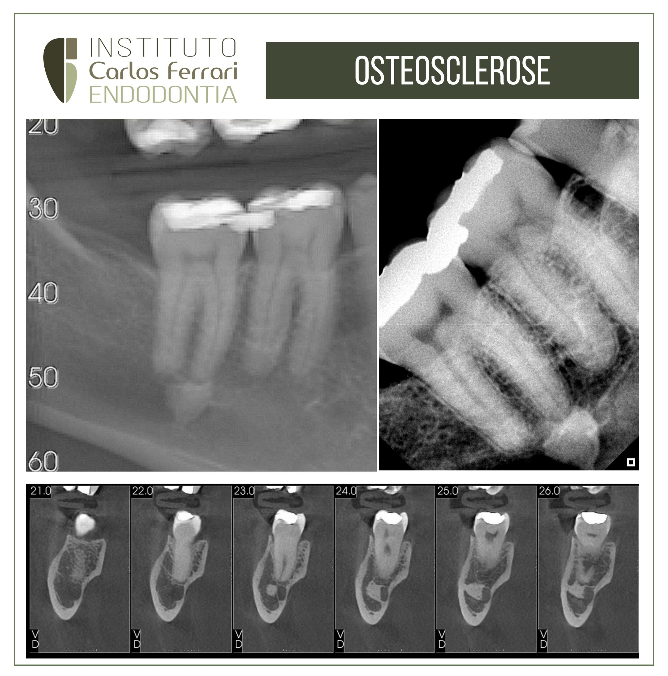 You are currently viewing Osteosclerosis in the apical region. Case report.