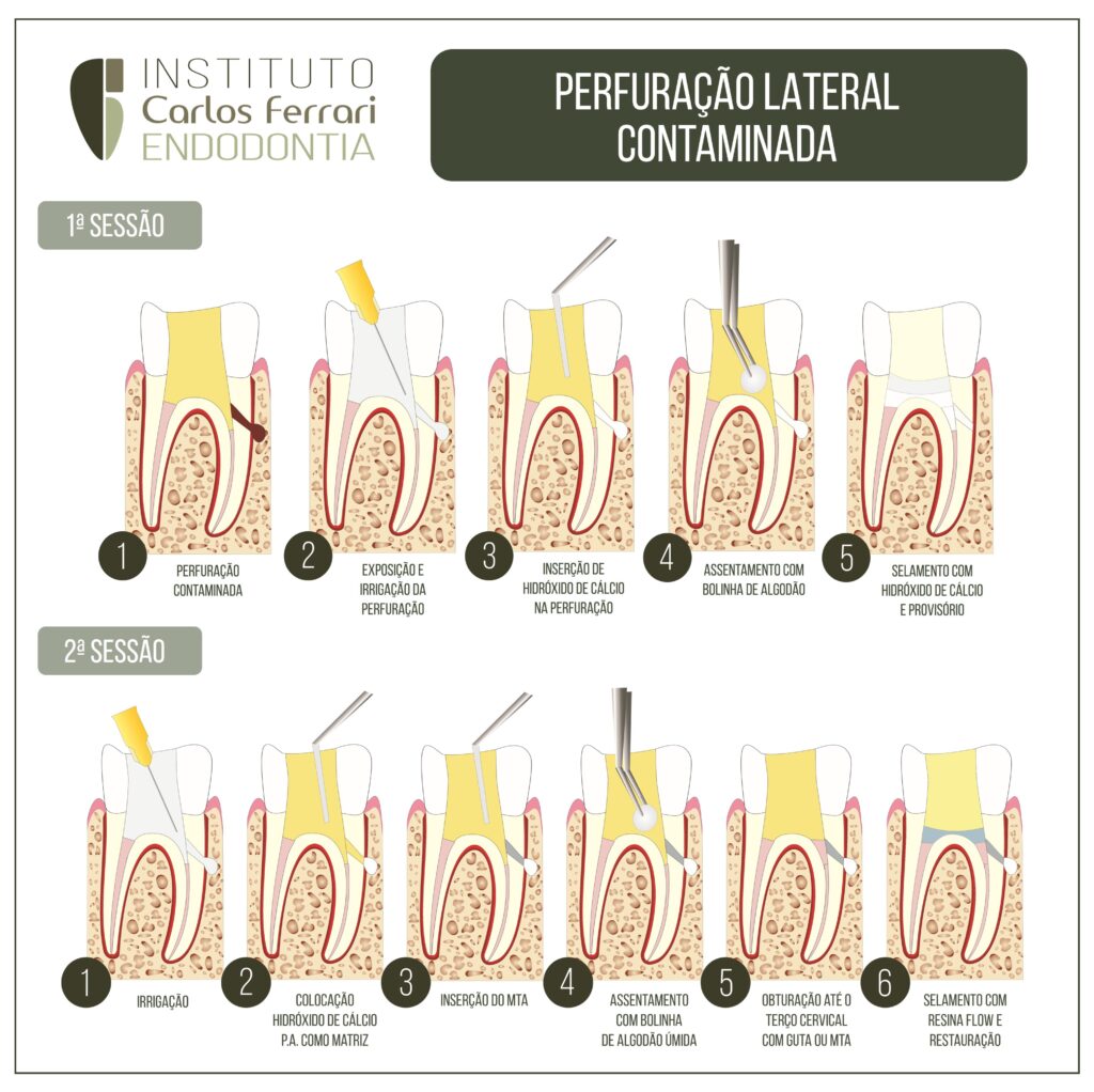 Read more about the article Contaminated lateral root perforation. What to do?
