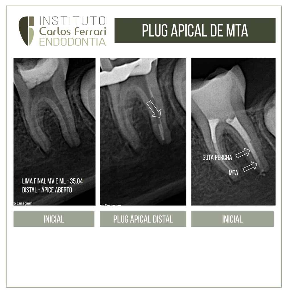 Read more about the article MTA apical plug in a tooth with incomplete rhizogenesis.