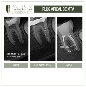 Read more about the article Plug apical de MTA em dente com rizogênese incompleta.