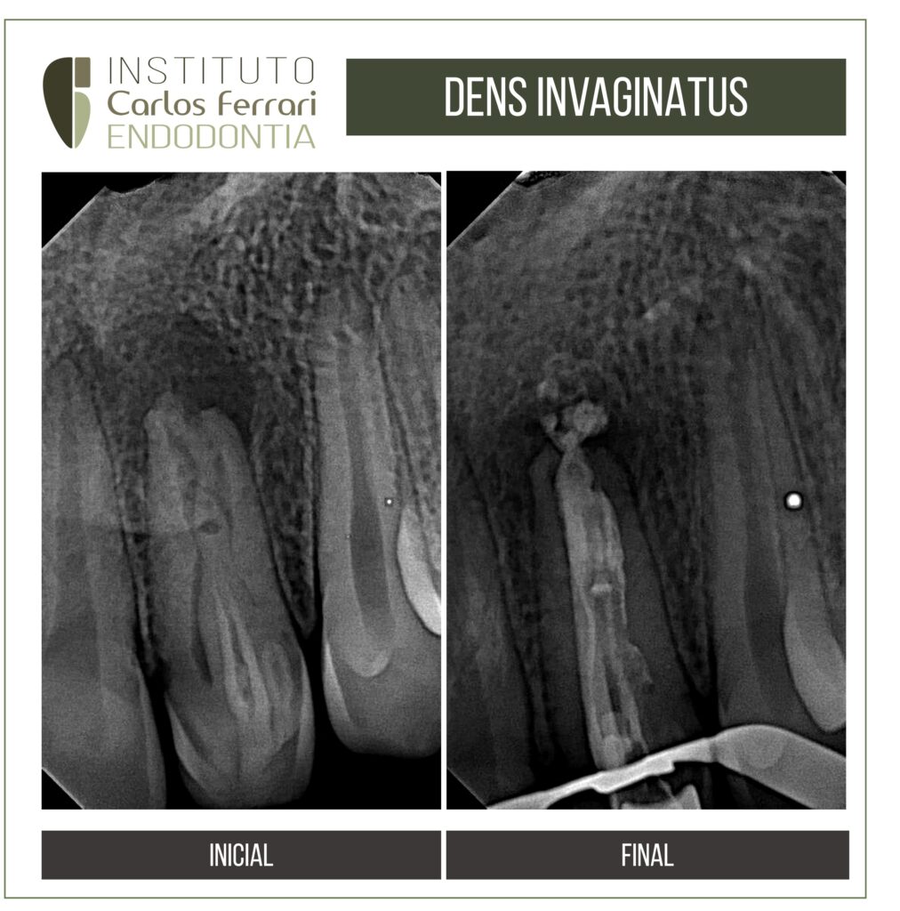 Read more about the article Endodontic treatment of dens invaginatus.